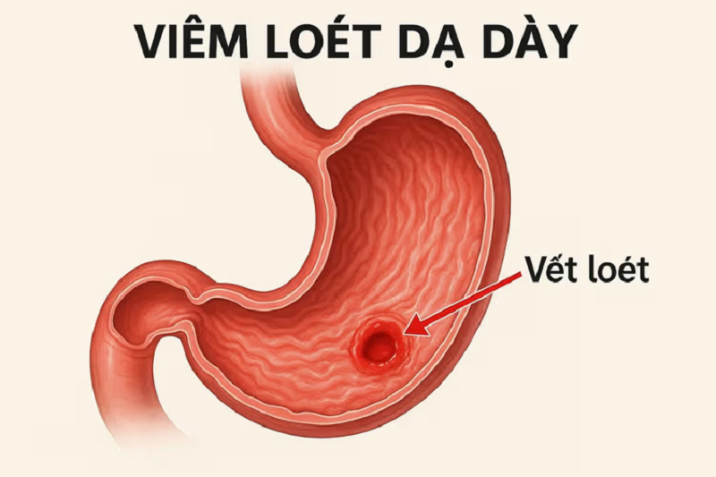 Tại sao NaHCO₃ được dùng làm thuốc đau dạ dày