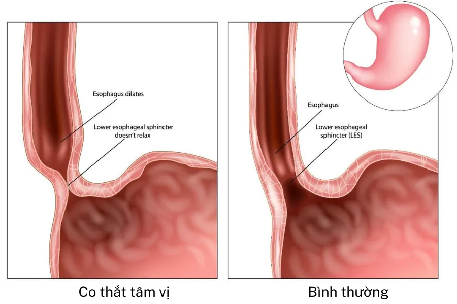 Những dạng rối loạn vận động thực quản thường gặp