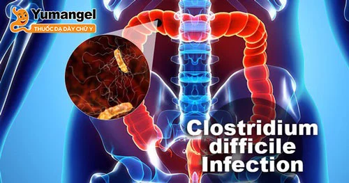 Vi khuẩn C. Difficile (Clostridium difficile/C. diff) là một trong những nguyên nhân chính gây ra bệnh viêm đại tràng màng giả mạc.