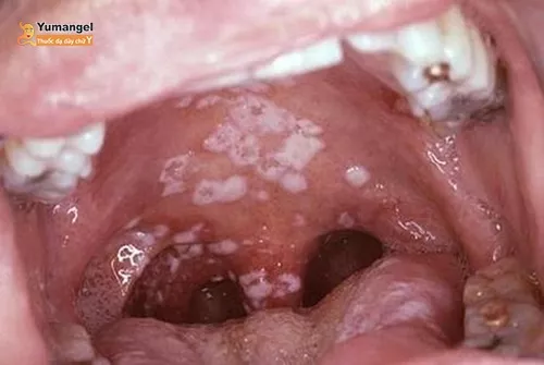 Nấm Candida có thể lan sâu vào nội tạng và tới cả miệng, họng. 