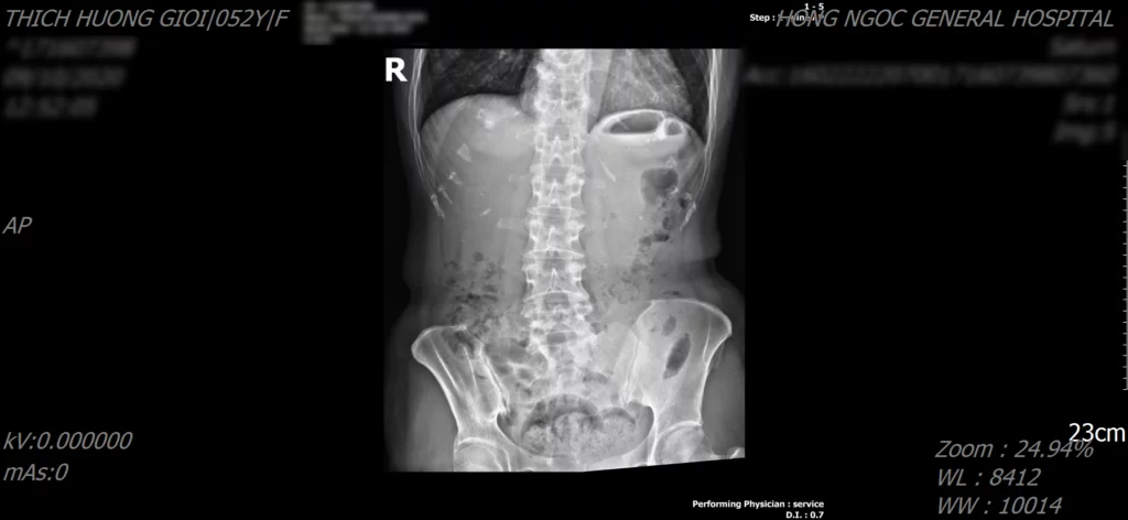 Hình ảnh X-quang thủng tạng rỗng
