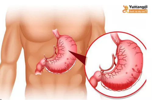 Chuyển sản ruột dạ dày được phân loại theo 3 cách khác nhau.