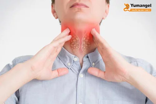 Triệu chứng nghẹn ở cổ họng và ợ hơi khó thở cảnh báo bệnh trào ngược dạ dày
