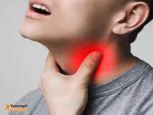 Cảm giác nghẹn ở cổ họng ợ hơi cảnh báo bệnh viêm thực quản