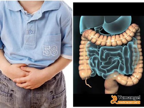“Tất tần tật” về hội chứng ruột kích thích ở trẻ em