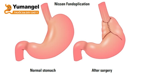 “Tất tần tật” về phẫu thuật Nissen điều trị trào ngược dạ dày