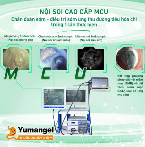 Công nghệ nội soi cao cấp MCU là sự kết hợp của phương pháp nội soi phóng đại nhuộm màu (MCE) và siêu âm nội soi (EUS).