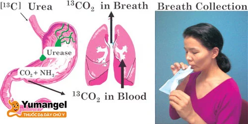 Xét nghiệm ure trong hơi thở tìm Hp dạ dày có độ chính xác hơn 95%.