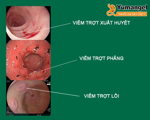 Ở giai đoạn viêm loét dạ dày cấp độ 1, niêm mạc dạ dày bị xung huyết sau đó hình thành các vết trầy xước. 