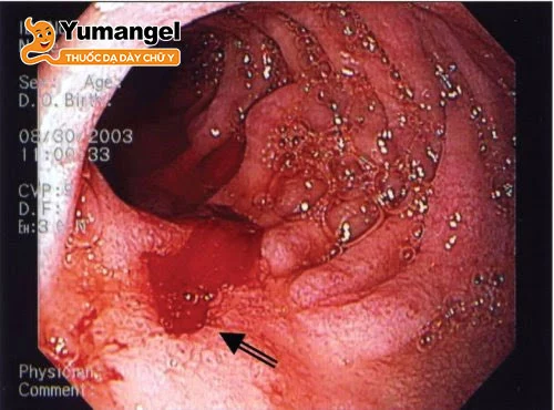 Viêm loét dạ dày cấp độ 3 và 4 không được điều trị kịp thời có thể gây xuất huyết, thủng dạ dày. 