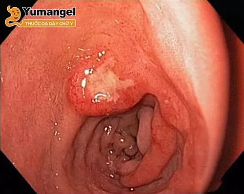 Bệnh loét nông hang vị dạ dày có thể do nhiễm khuẩn vi rút, vi khuẩn, chế độ ăn uống không khoa học, tác dụng phụ của thuốc hoặc căng thẳng.