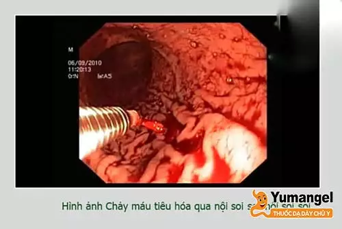 Chảy máu trong hay xuất huyết tiêu hóa là biến chứng thường gặp nhất của loét nông hang vị dạ dày.