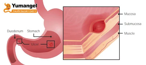 Viêm loét dạ dày là tình trạng tổn thương lớp mô của dạ dày.