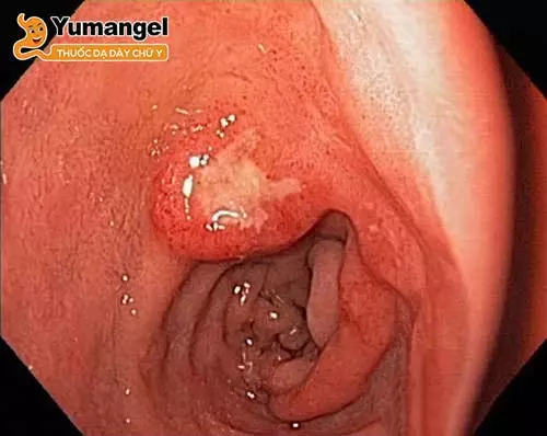 Nhiễm vi khuẩn HP, lạm dụng thuốc NSAID là nguyên nhân chính gây viêm hang vị tiền môn vị.