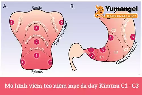 Hình ảnh vị trí của viêm teo niêm mạc dạ dày C2.